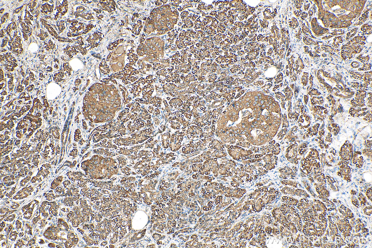 IHC staining of human pancreas cancer using 16247-1-AP