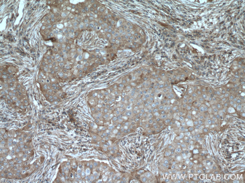 IHC staining of human breast cancer using 14822-1-AP