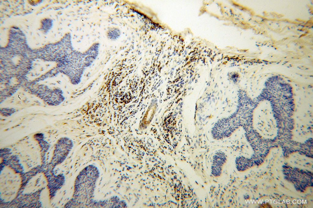 IHC staining of human skin cancer using 14176-1-AP