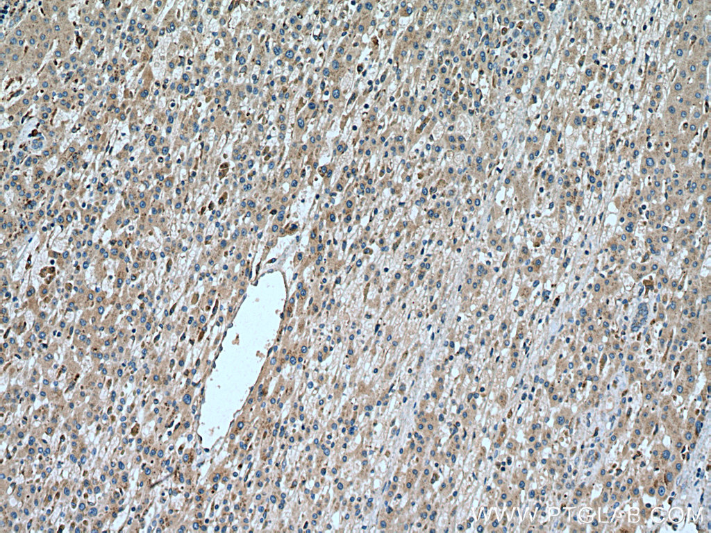 IHC staining of human liver cancer using 15428-1-AP