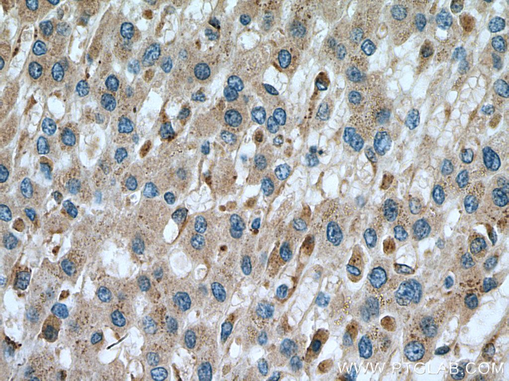 IHC staining of human liver cancer using 15428-1-AP