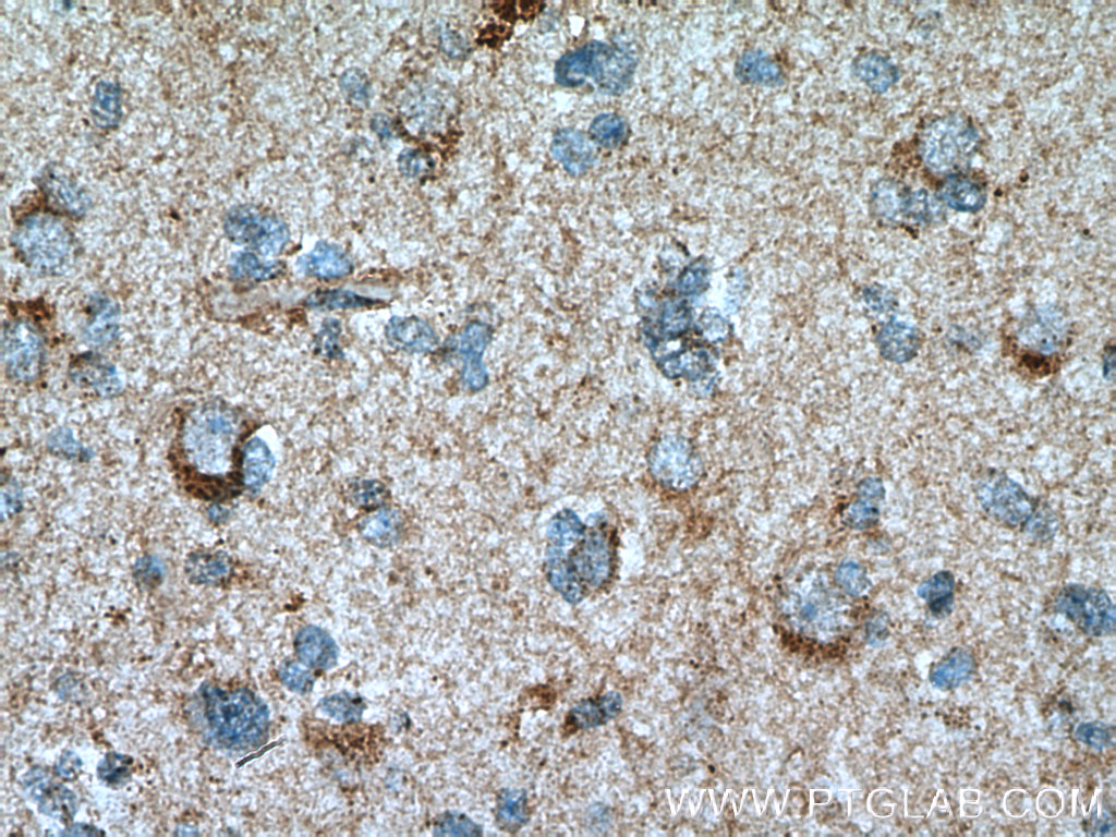IHC staining of human gliomas using 15518-1-AP