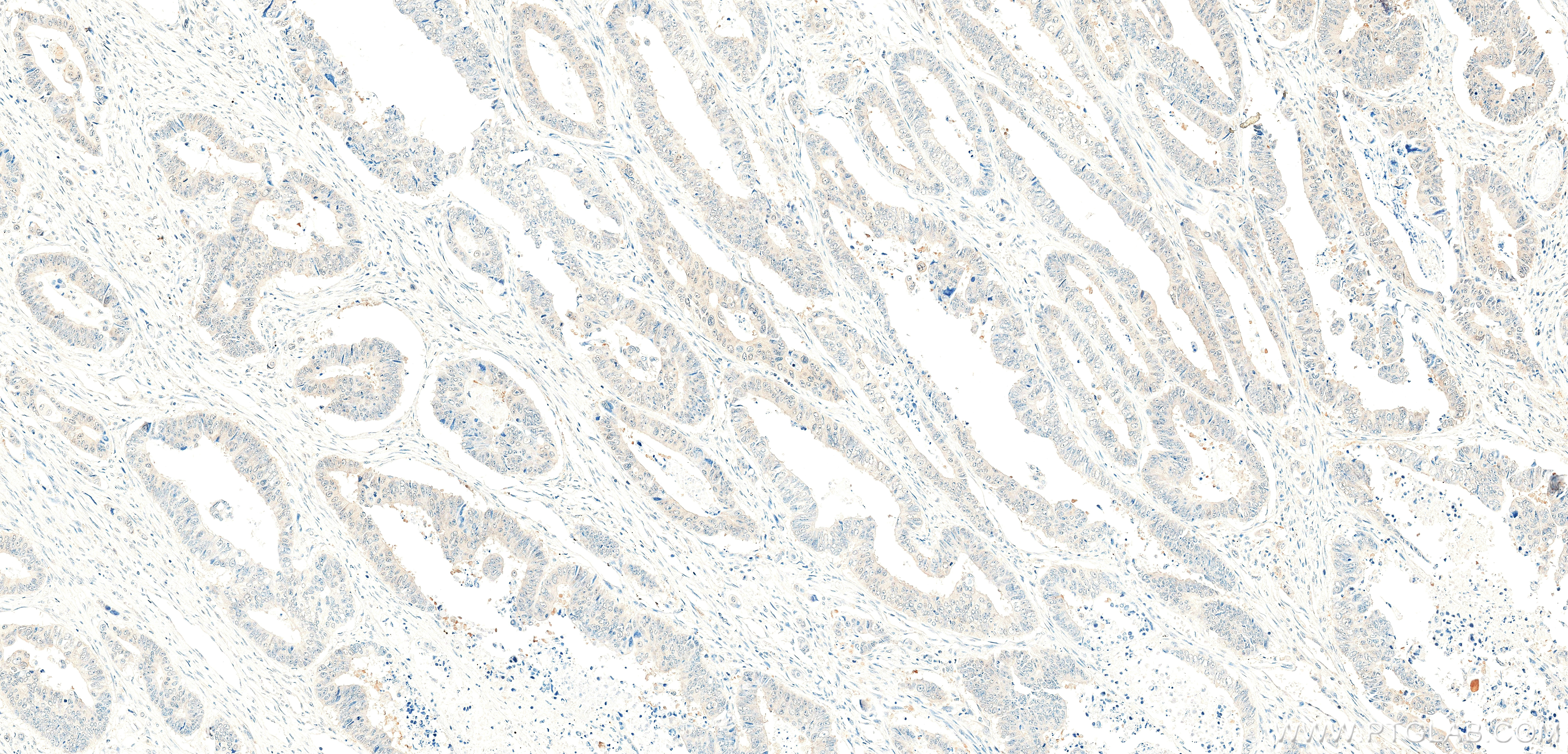 IHC staining of human colon cancer using 86587-1-RR (same clone as 86587-1-PBS) IHC staining of human colon cancer using 86587-1-RR (same clone as 86587-1-PBS)