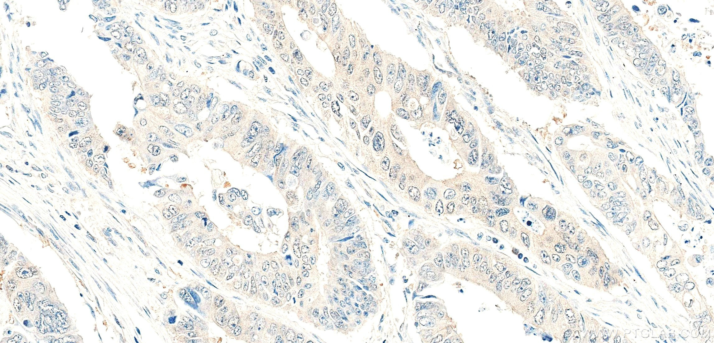 IHC staining of human colon cancer using 86587-1-RR (same clone as 86587-1-PBS) IHC staining of human colon cancer using 86587-1-RR (same clone as 86587-1-PBS)