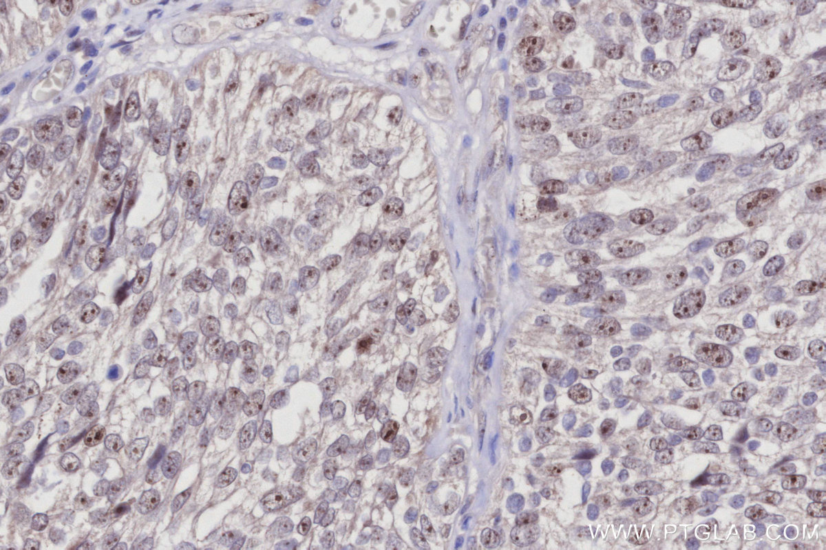 IHC staining of human ovary cancer using 27353-1-AP IHC staining of human ovary cancer using 27353-1-AP