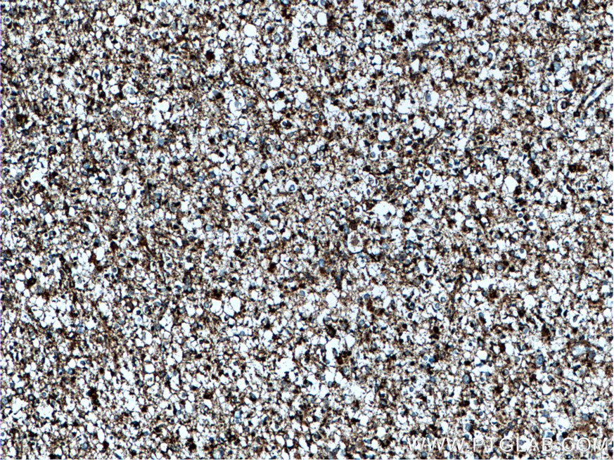 IHC staining of human gliomas using 14299-1-AP