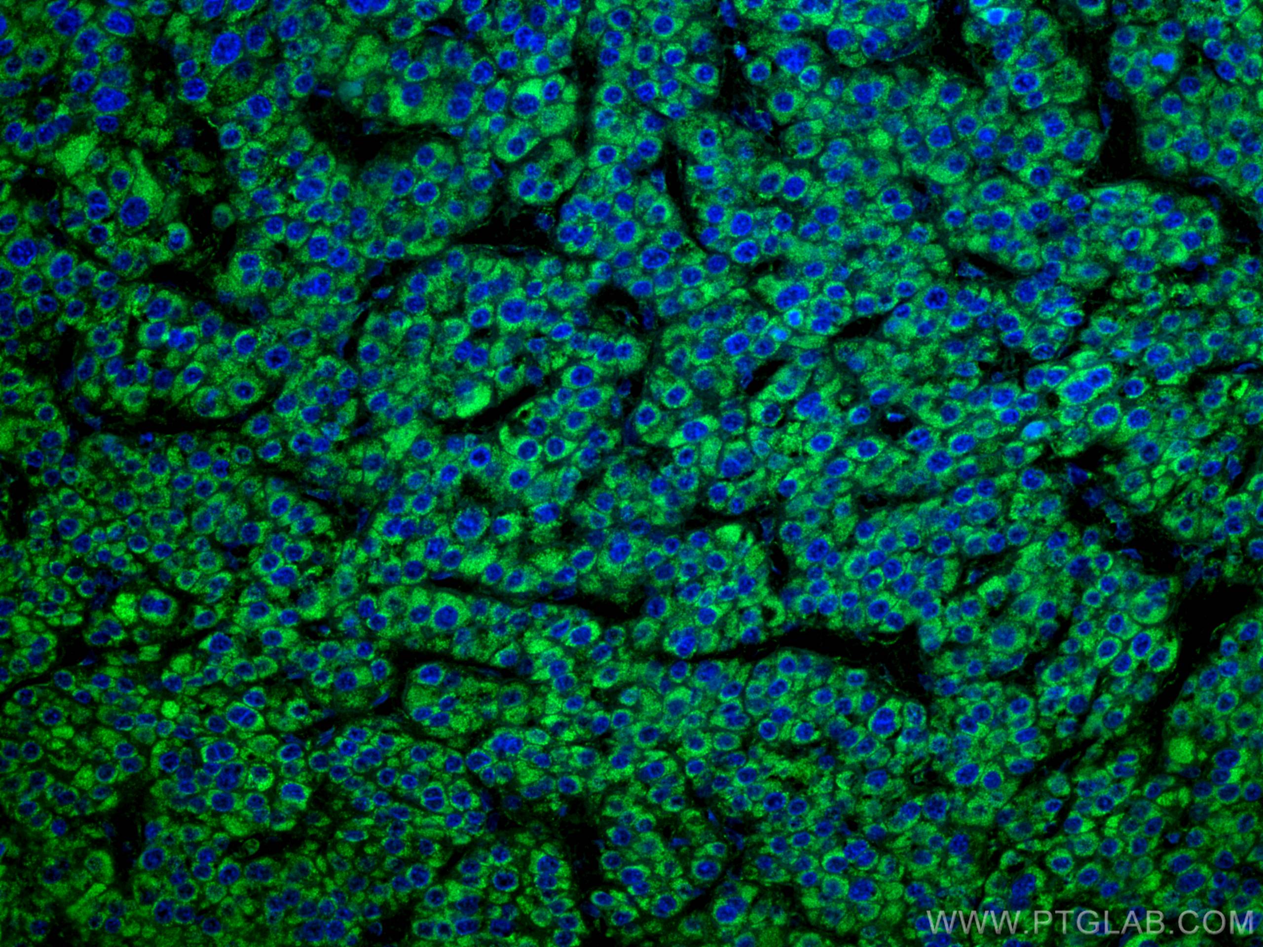 IF Staining of human liver cancer using 67026-1-Ig