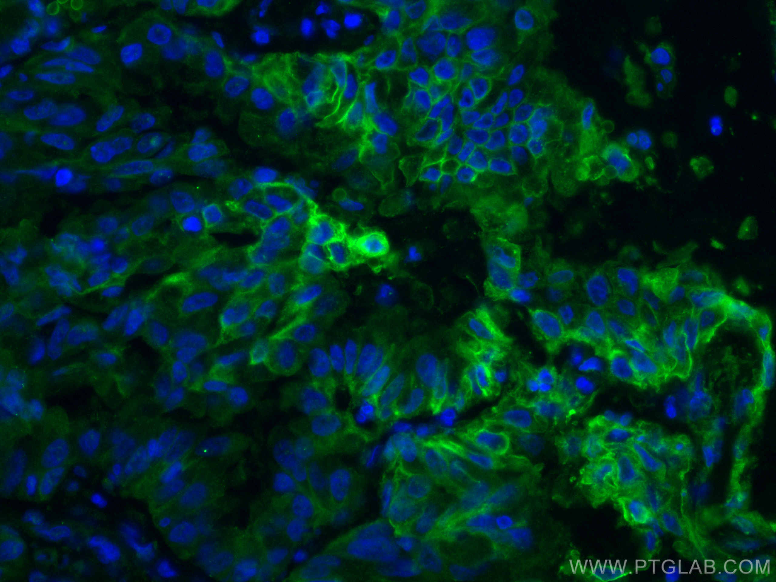 IF Staining of human lung cancer using 66290-1-Ig