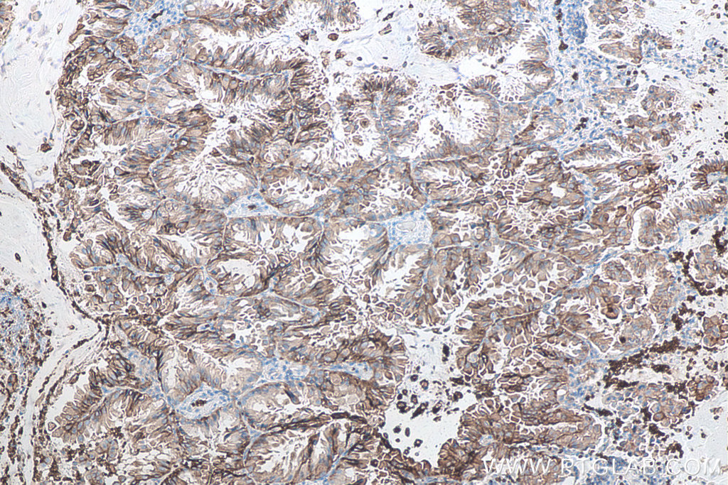 IHC staining of human lung cancer using 66290-1-Ig