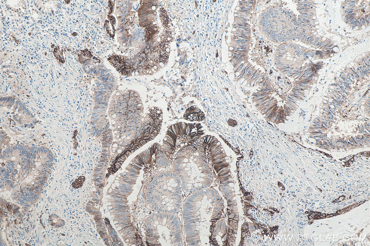 IHC staining of human colon cancer using 66290-1-Ig