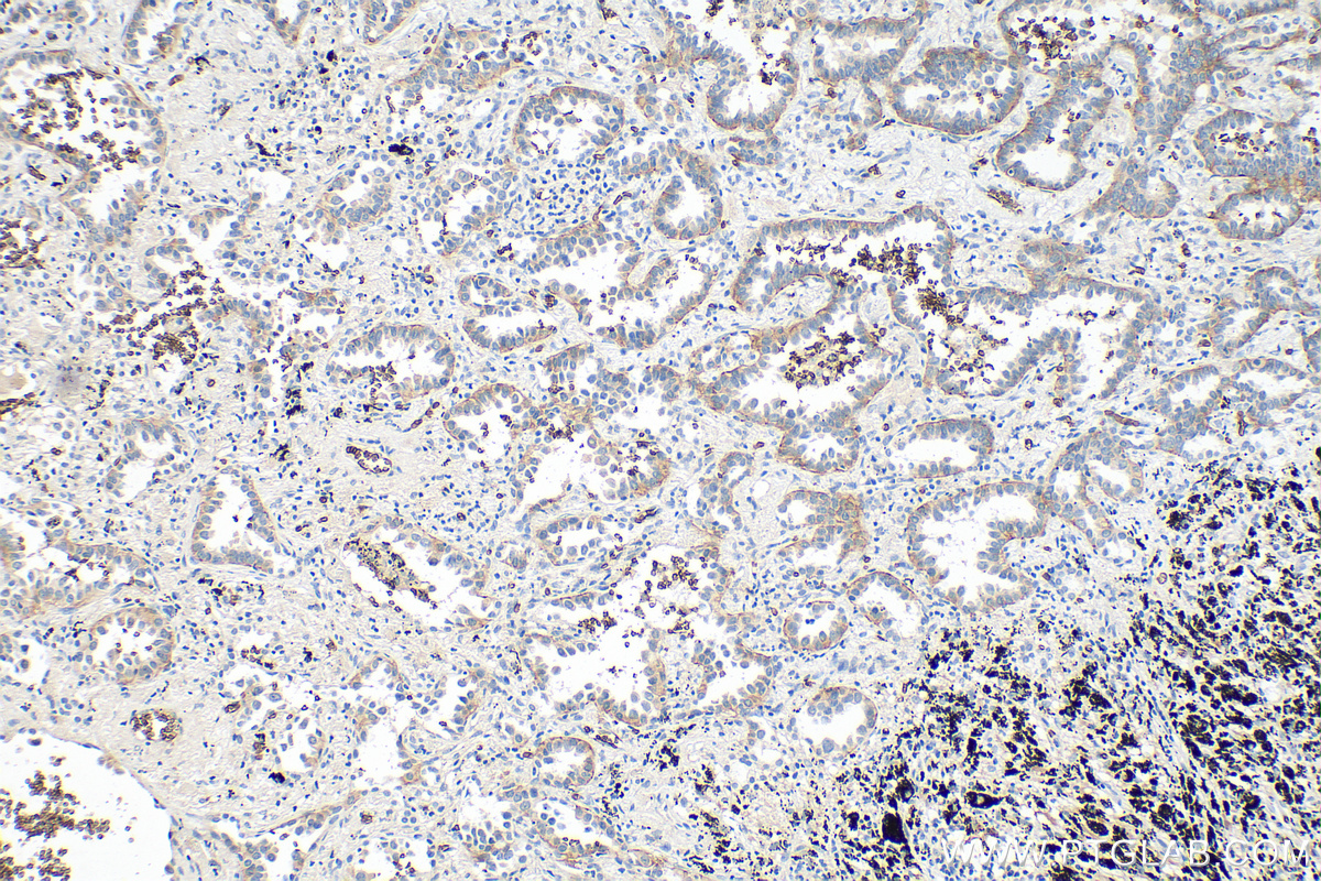 IHC staining of human lung cancer using 66290-1-Ig