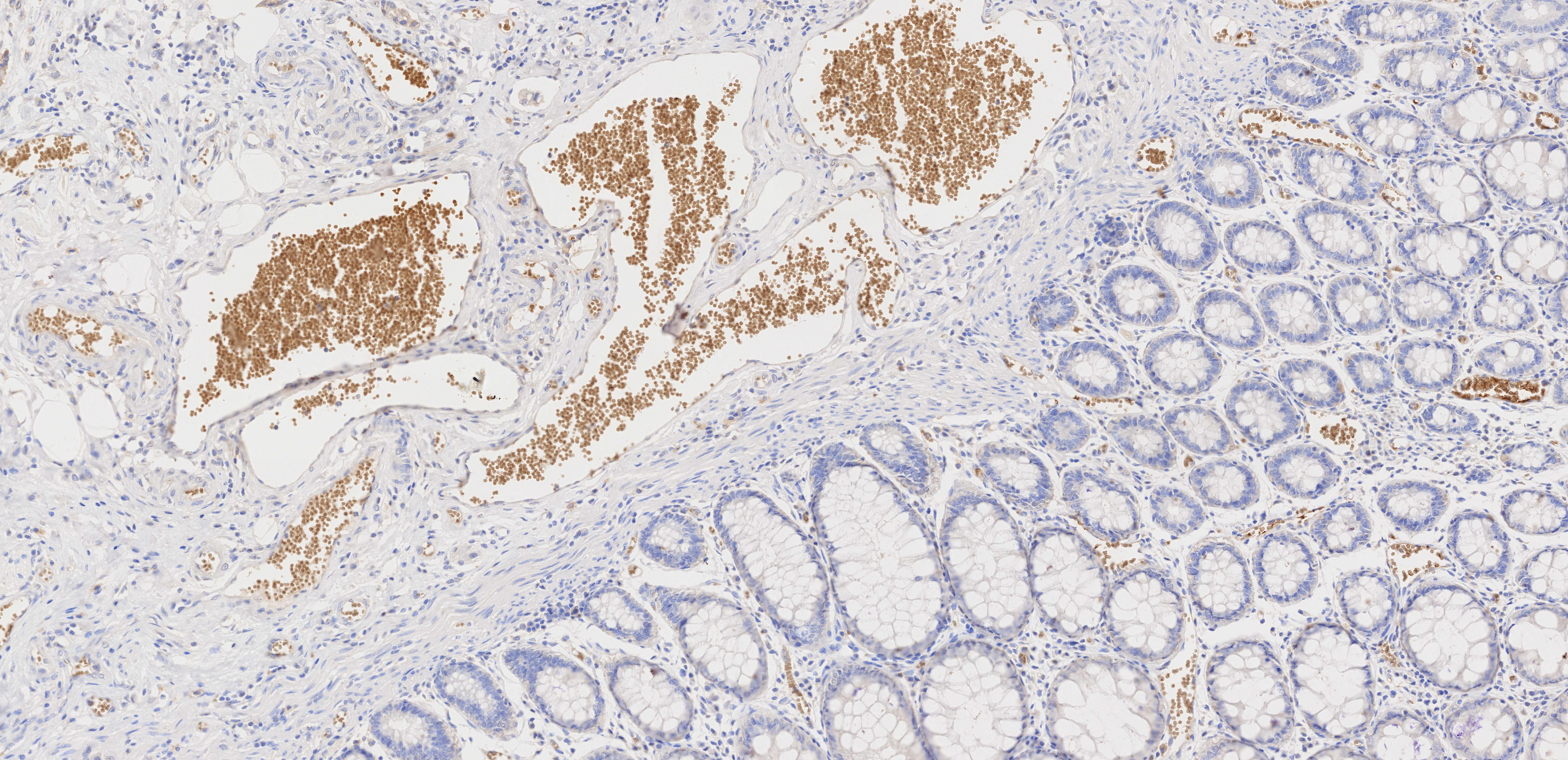 IHC staining of human rectal cancer using 66290-1-Ig