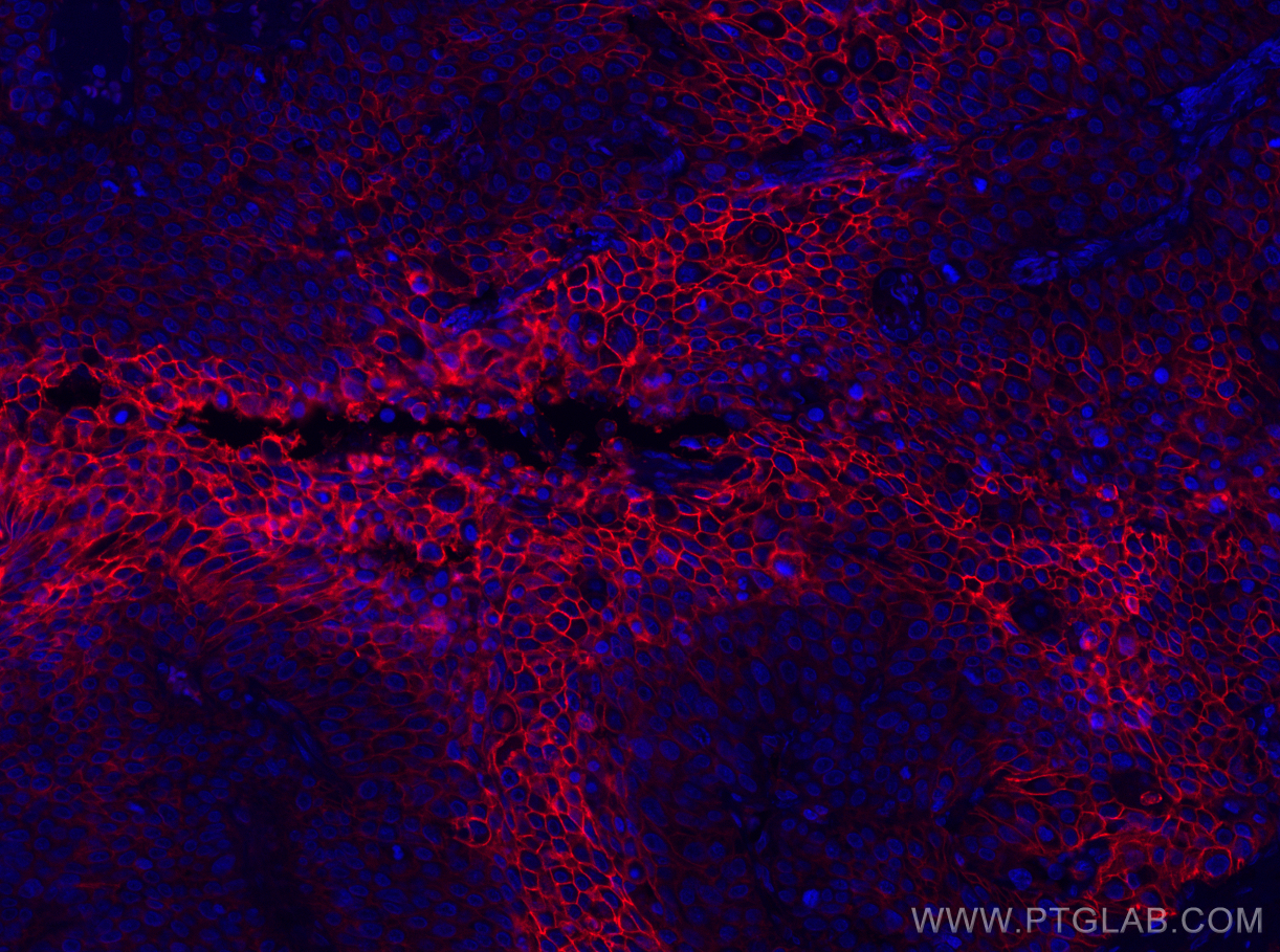 IF Staining of human lung cancer using CL594-66290