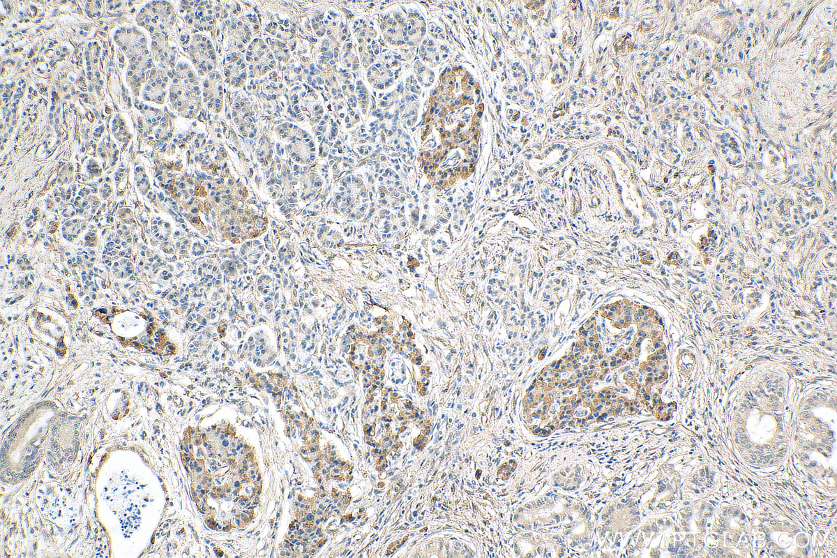 IHC staining of human pancreas cancer using 66889-1-Ig