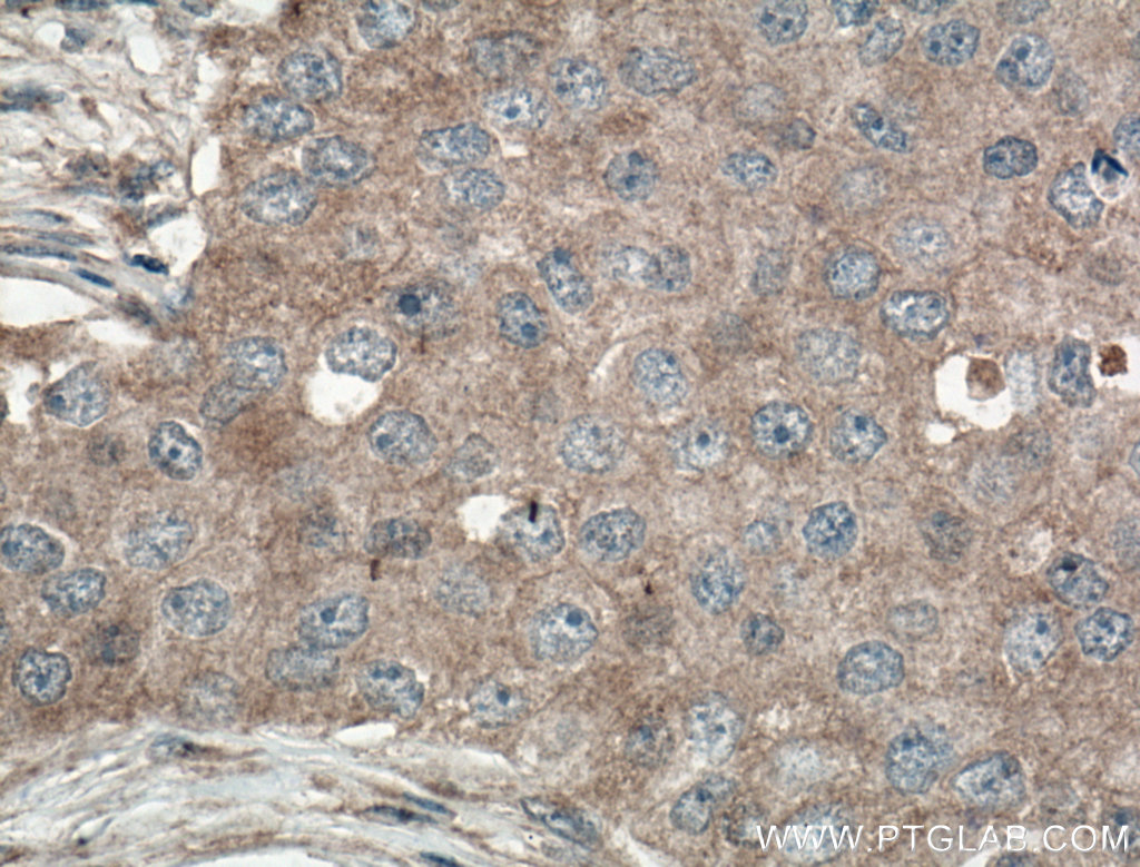 IHC staining of human breast cancer using 27571-1-AP