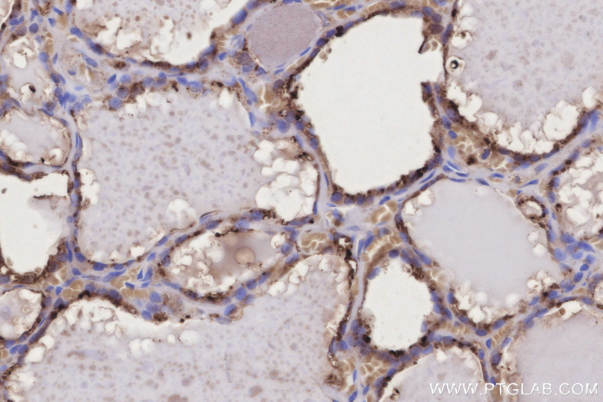 IHC staining of human thyroid cancer using 66080-1-Ig