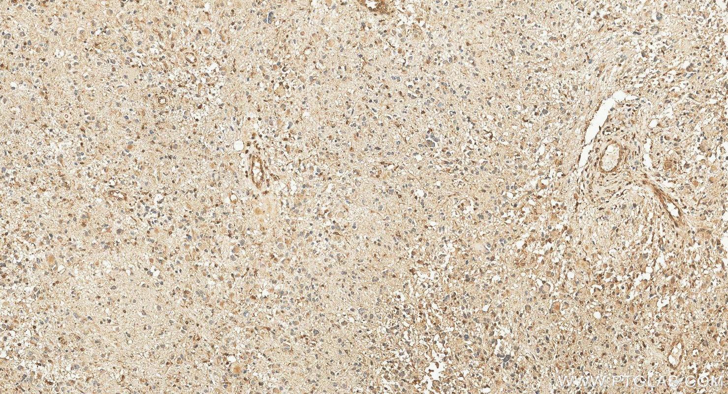 IHC staining of human gliomas using 13625-1-AP IHC staining of human gliomas using 13625-1-AP