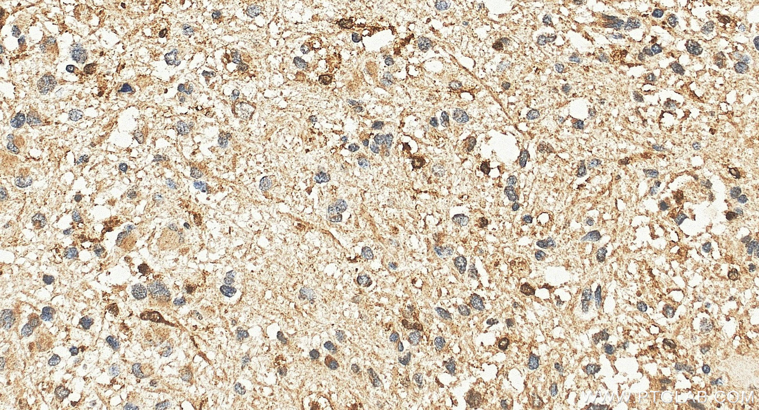 IHC staining of human gliomas using 13625-1-AP IHC staining of human gliomas using 13625-1-AP
