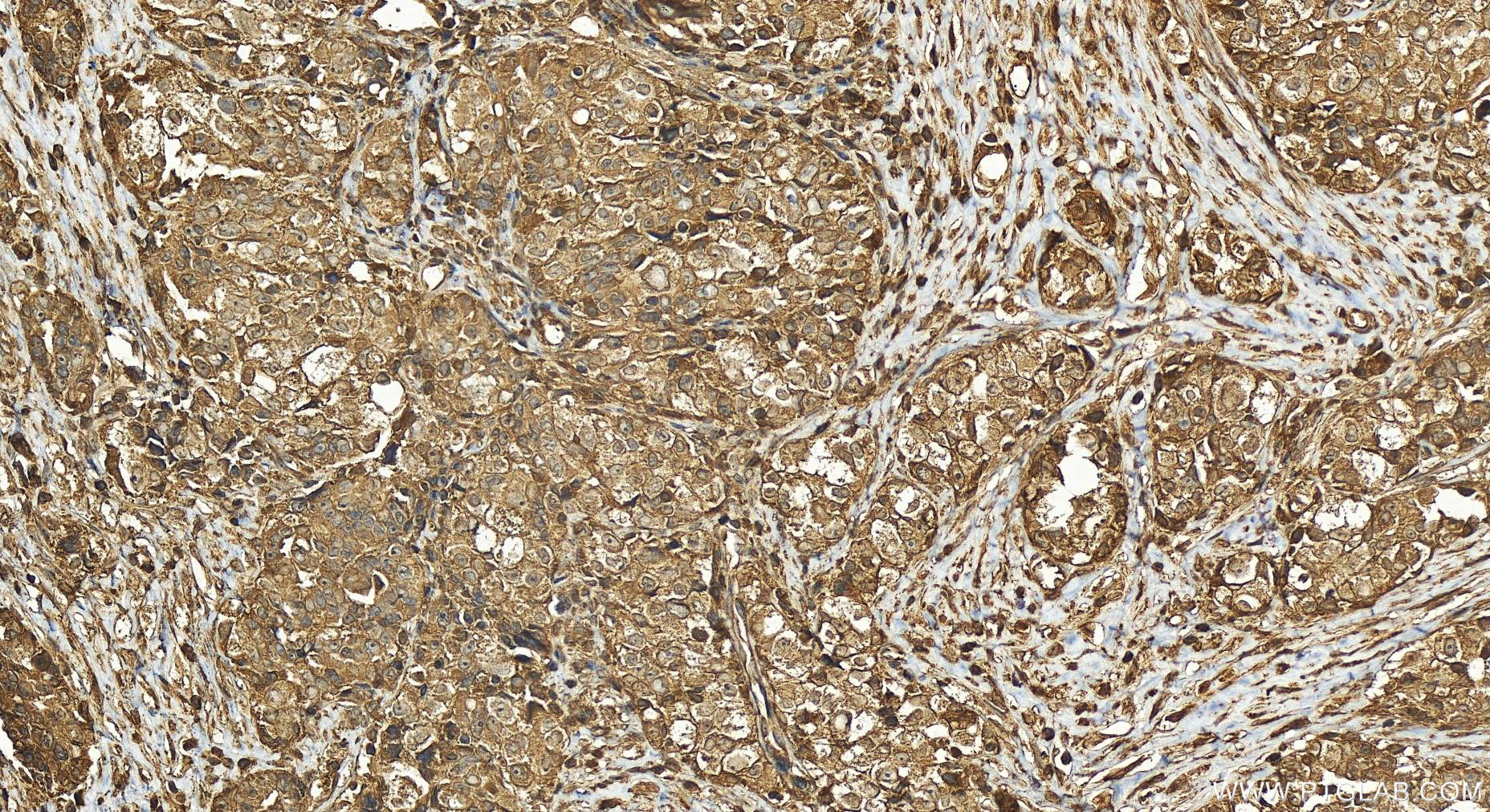 IHC staining of human ovary cancer using 25917-1-AP