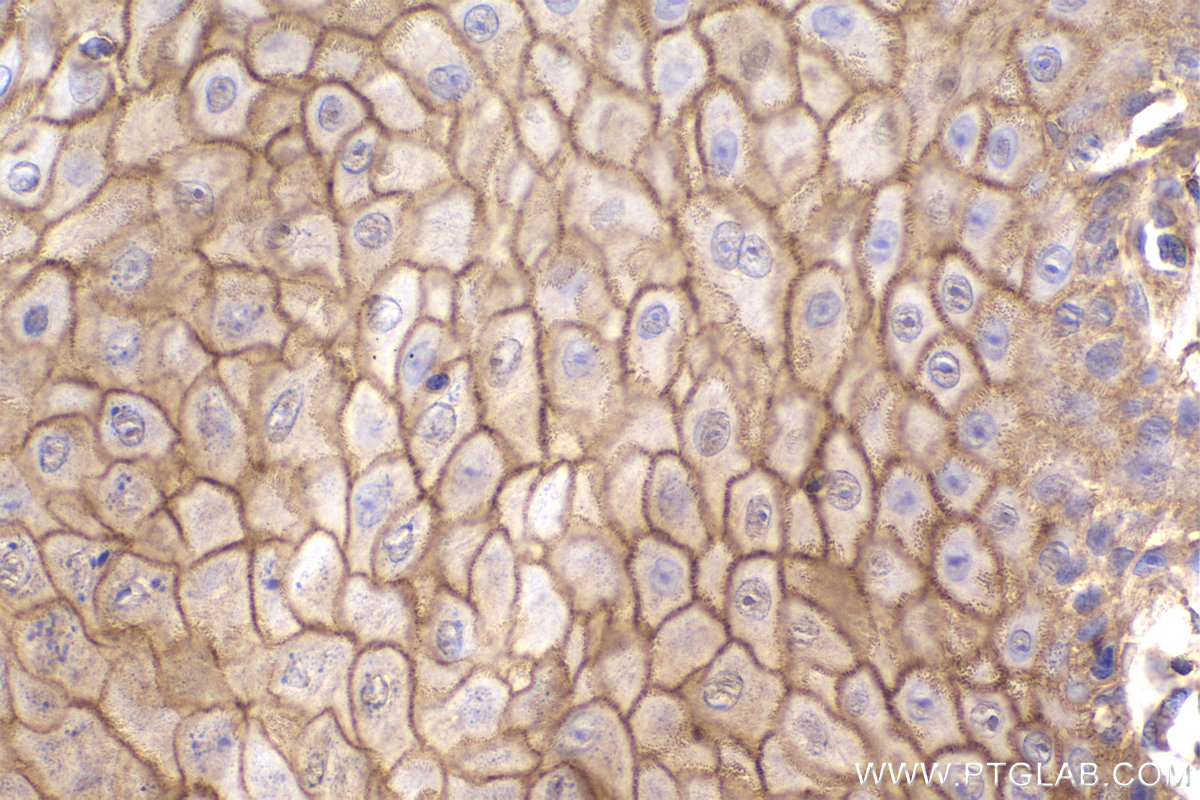 IHC staining of human skin cancer using 68156-1-Ig (same clone as 68156-1-PBS) IHC staining of human skin cancer using 68156-1-Ig (same clone as 68156-1-PBS)