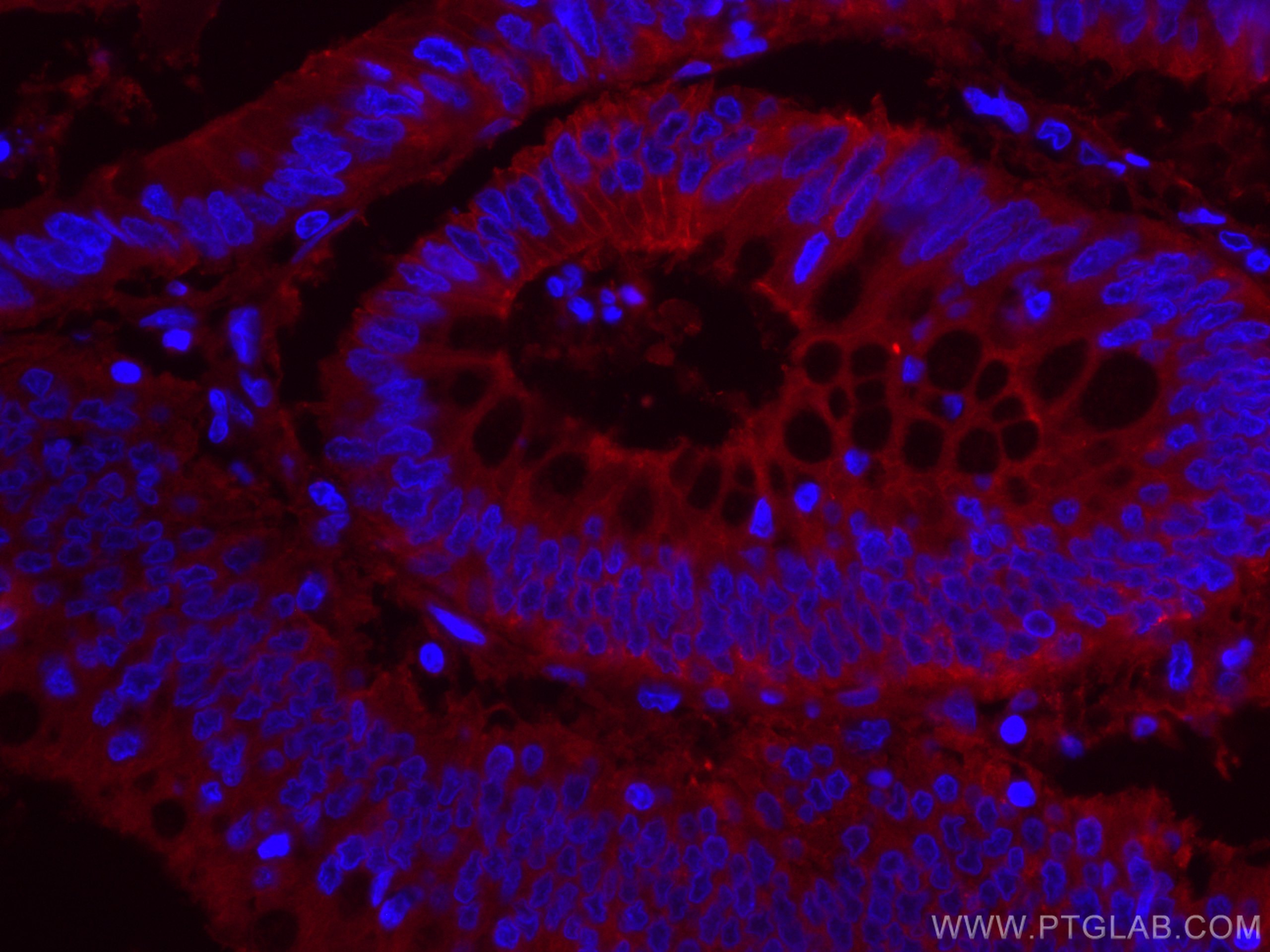IF Staining of human colon cancer using CL594-66253