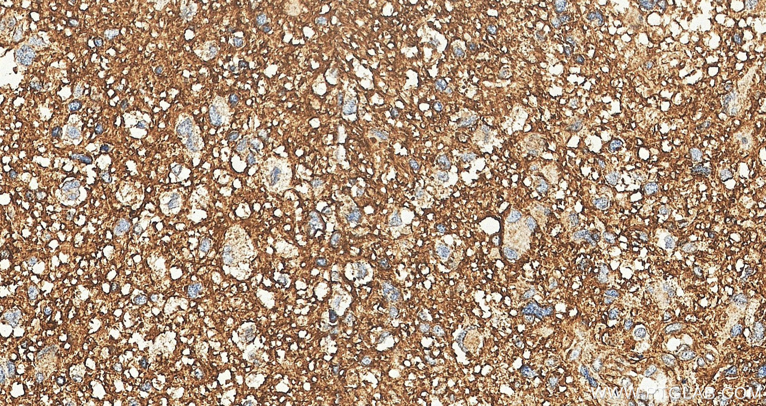 IHC staining of human gliomas using 10247-2-AP (same clone as 10247-2-PBS) IHC staining of human gliomas using 10247-2-AP (same clone as 10247-2-PBS)