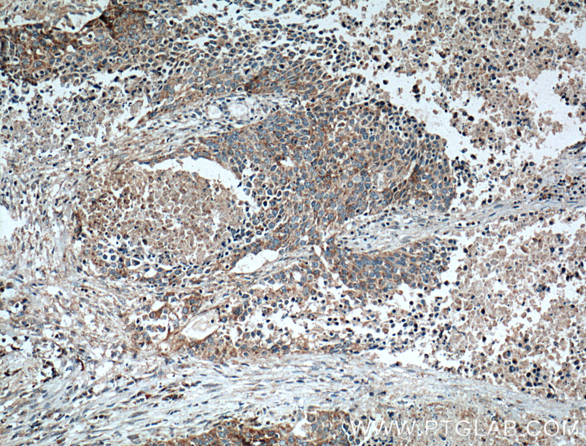 IHC staining of human lung cancer using 10076-1-AP