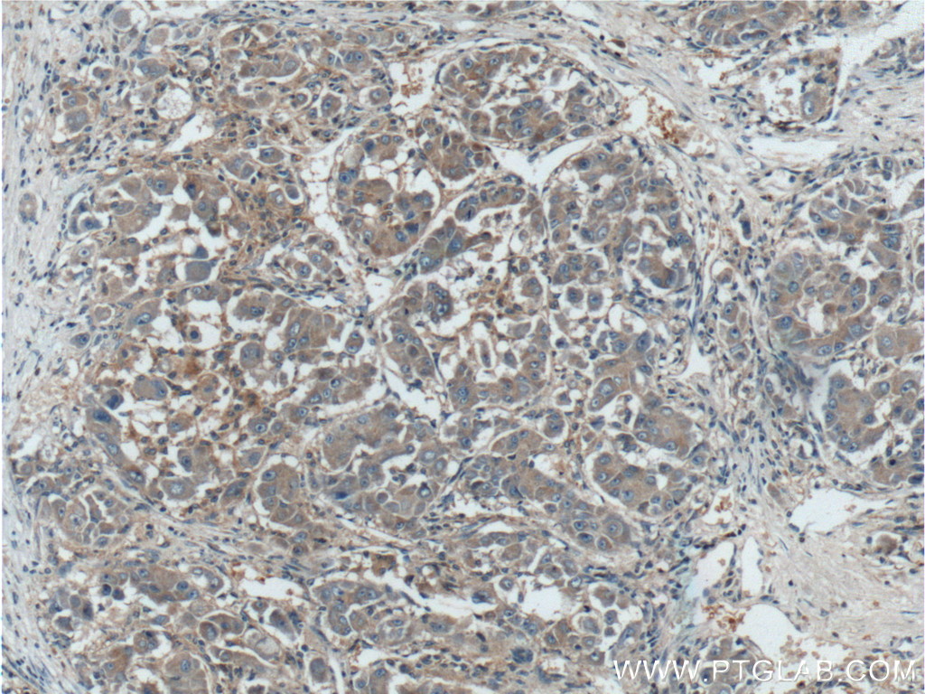 IHC staining of human liver cancer using 10081-1-AP