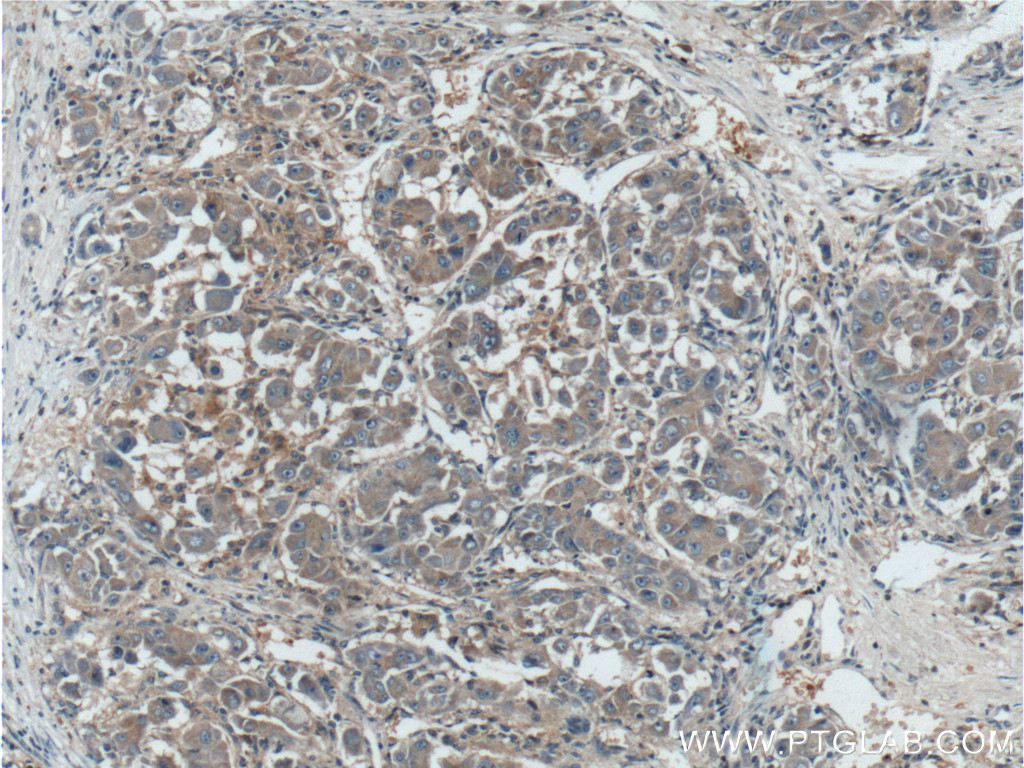 IHC staining of human liver cancer using 10081-1-AP (same clone as 10081-1-PBS)