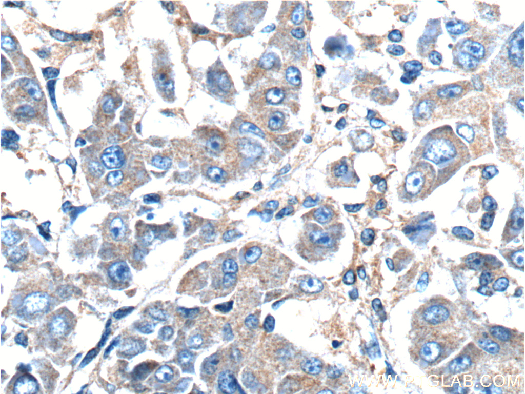 IHC staining of human liver cancer using 10081-1-AP (same clone as 10081-1-PBS)