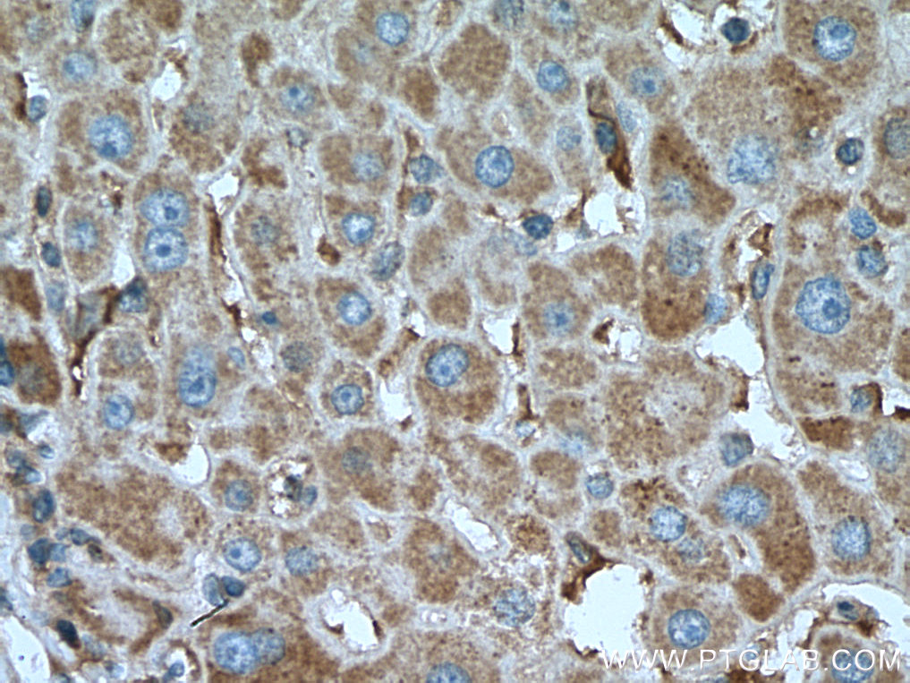 IHC staining of human liver cancer using 67497-1-Ig (same clone as 67497-1-PBS)