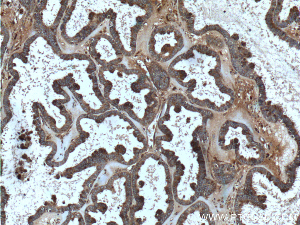 IHC staining of human ovary tumor using 11045-2-AP