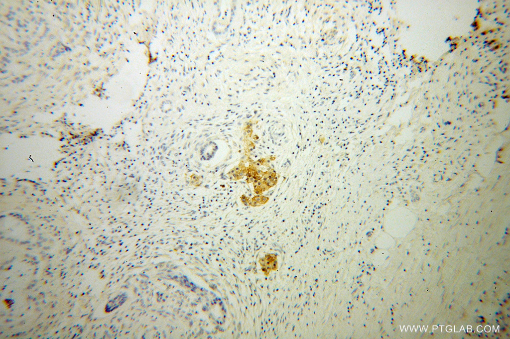 IHC staining of human pancreas cancer using 13780-1-AP