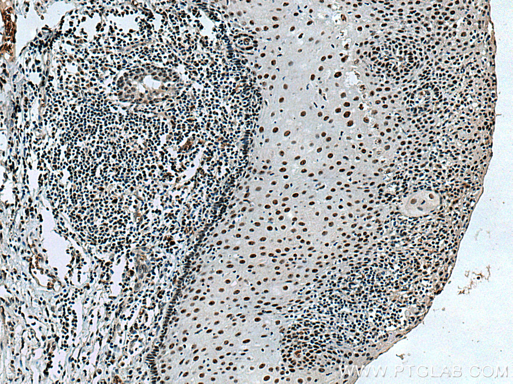 IHC staining of human oesophagus cancer using 15060-1-AP