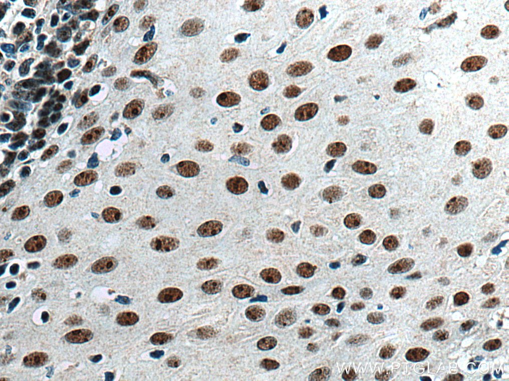 IHC staining of human oesophagus cancer using 15060-1-AP