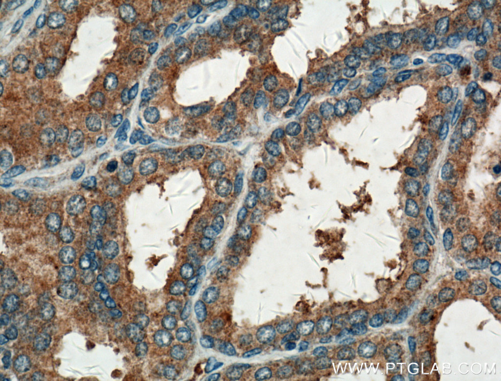 IHC staining of human prostate hyperplasia using 18790-1-AP (same clone as 18790-1-PBS)