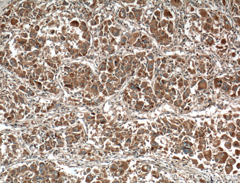 IHC staining of human liver cancer using 66453-1-Ig