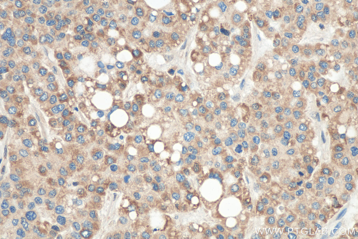 IHC staining of human liver cancer using 20728-1-AP