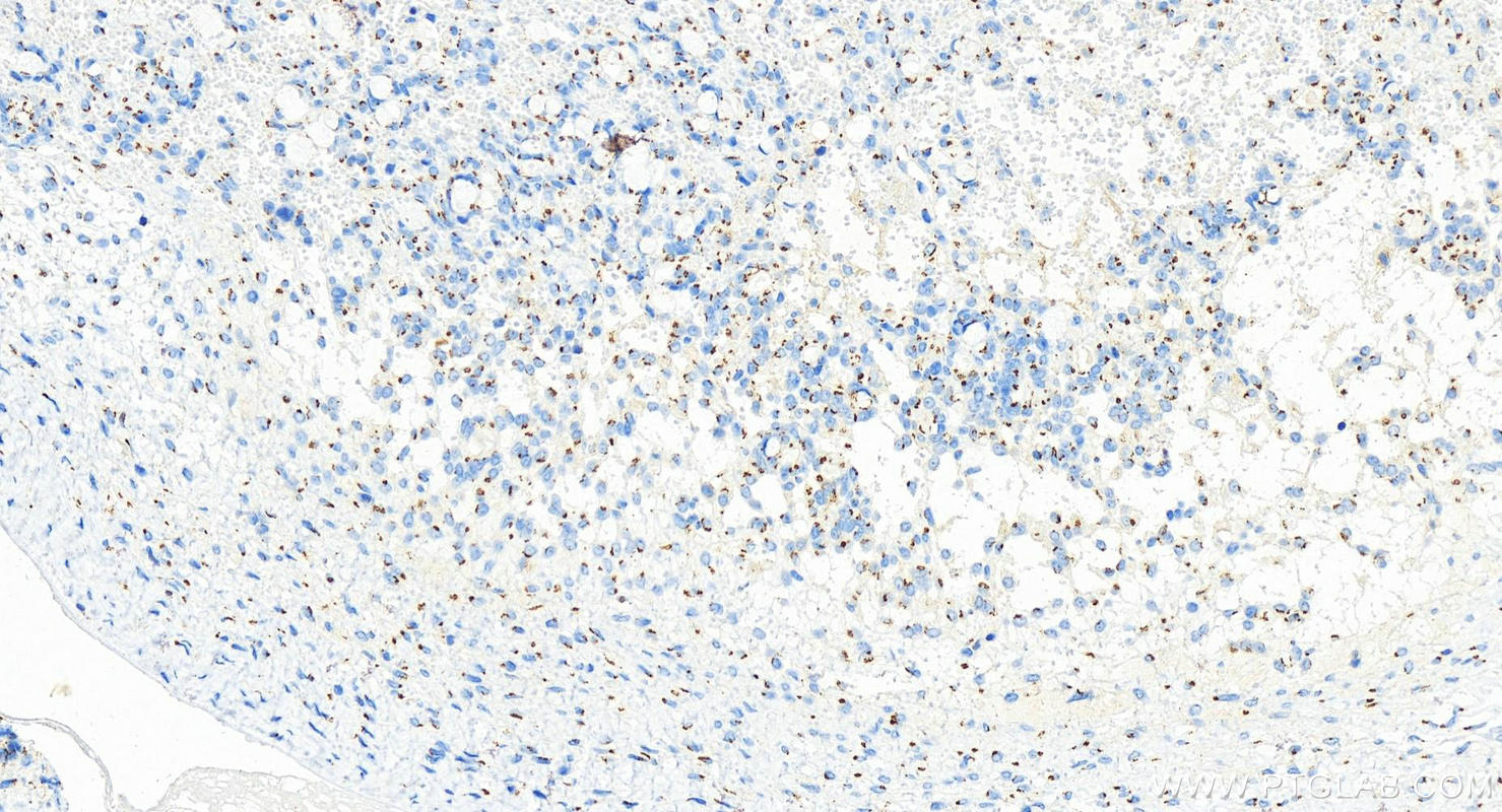 IHC staining of human ovary cancer using 83839-2-RR (same clone as 83839-2-PBS)