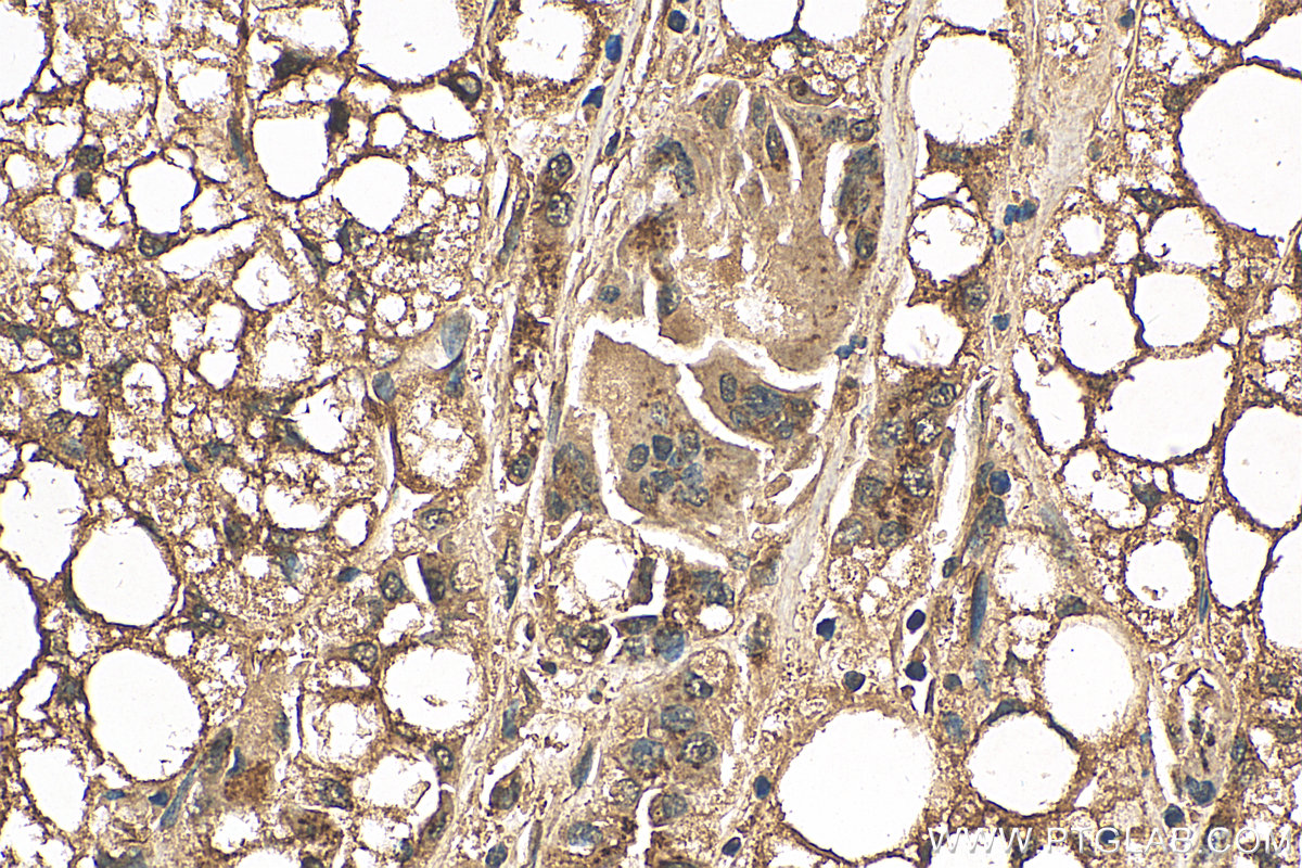 IHC staining of human liver cancer using 15126-1-AP