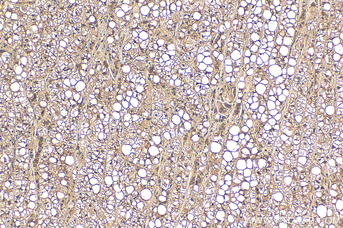 IHC staining of human liver cancer using 15126-1-AP