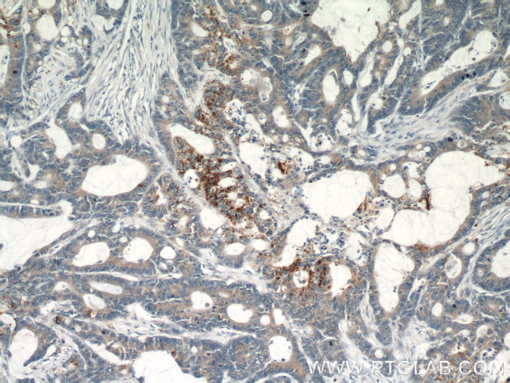 IHC staining of human colon cancer using 19112-1-AP