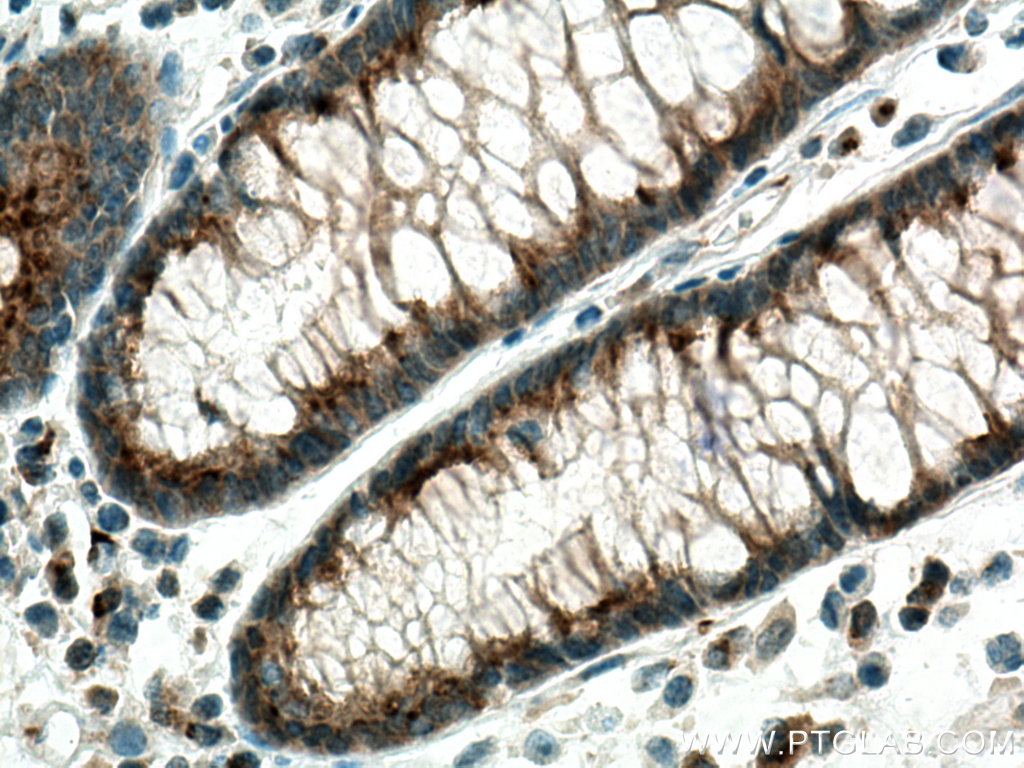 IHC staining of human colon cancer using 67777-1-Ig