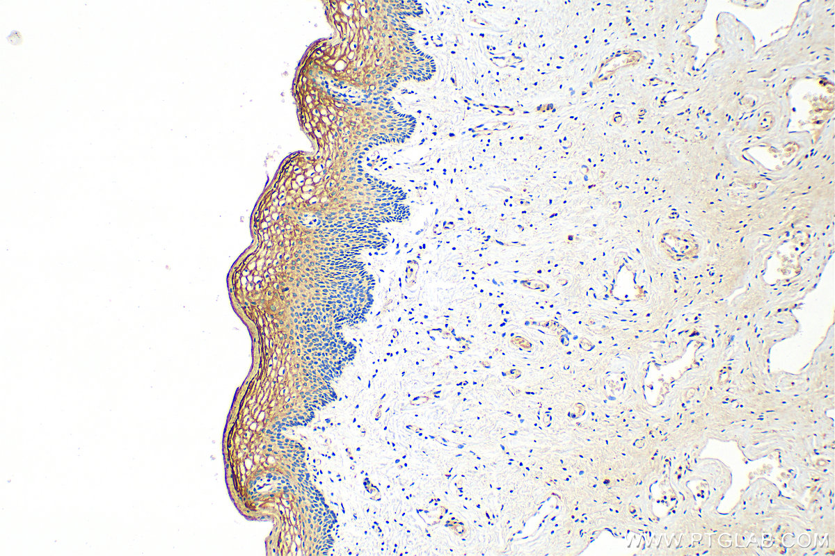 IHC staining of human cervical cancer using 23153-1-AP
