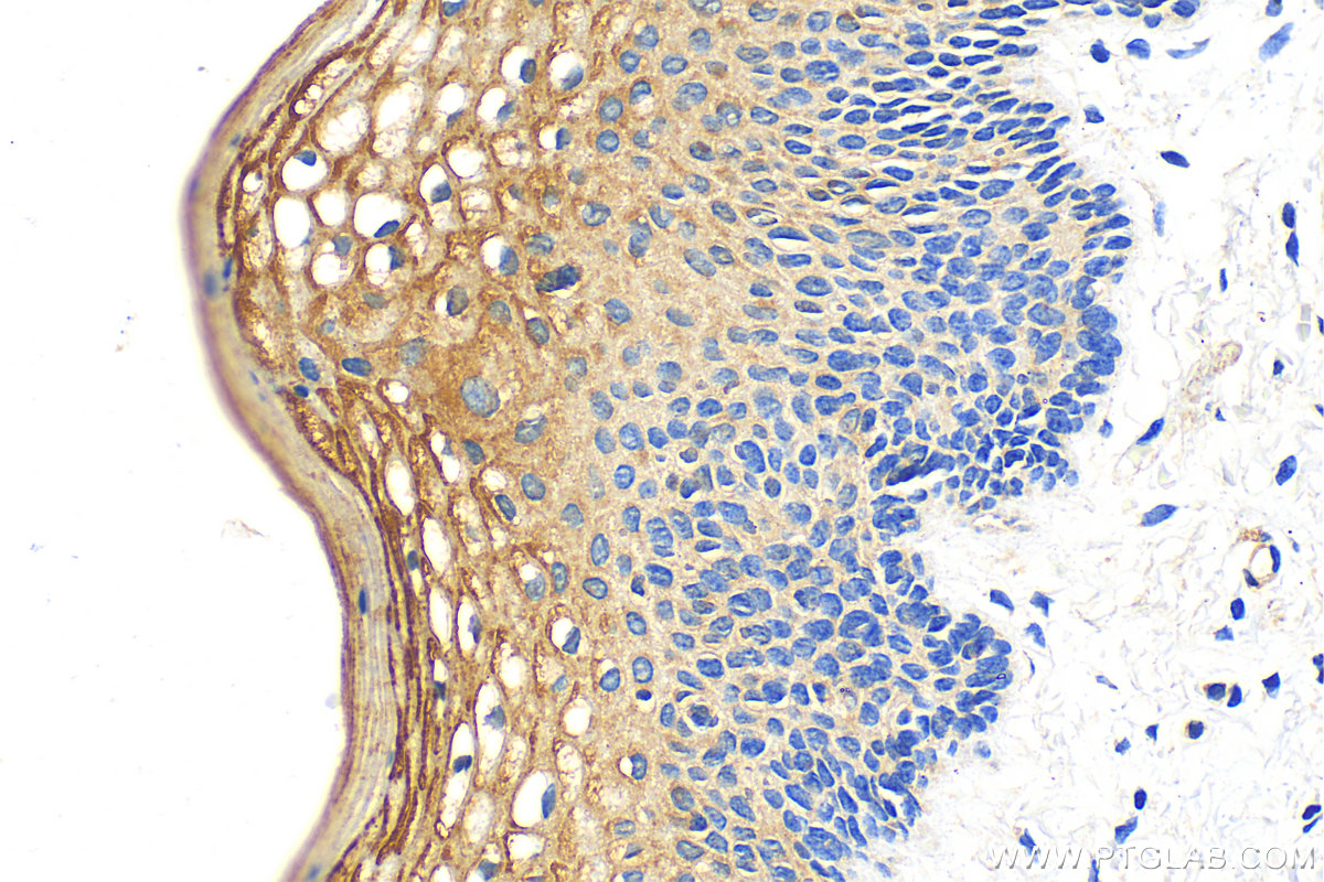 IHC staining of human cervical cancer using 23153-1-AP