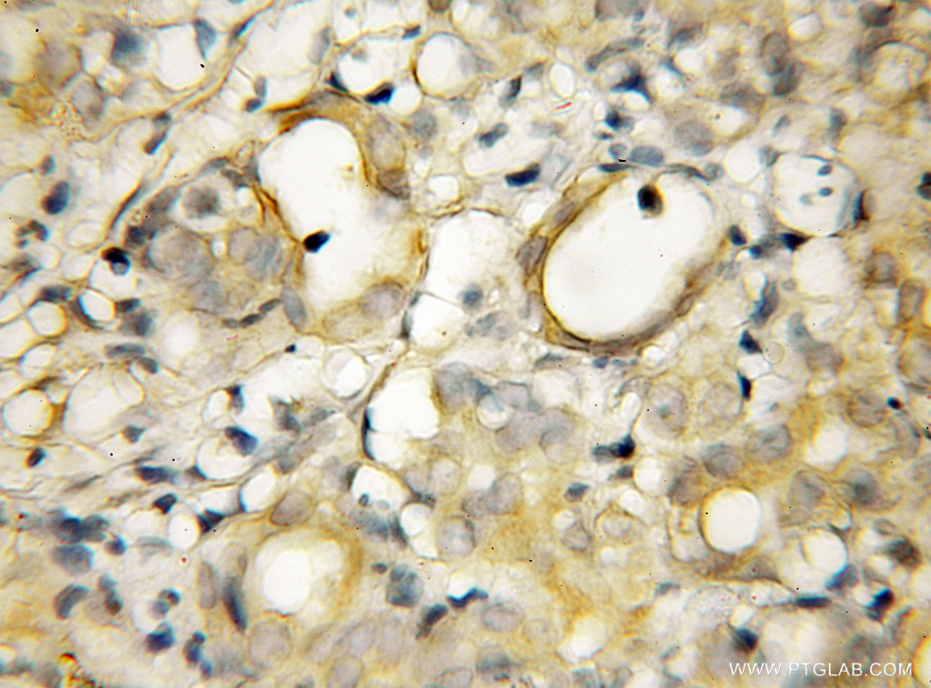 IHC staining of human pancreas cancer using 12163-1-AP