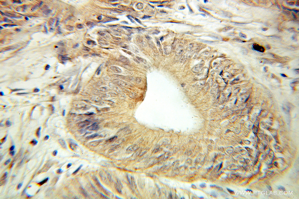 IHC staining of human colon cancer using 10598-1-AP