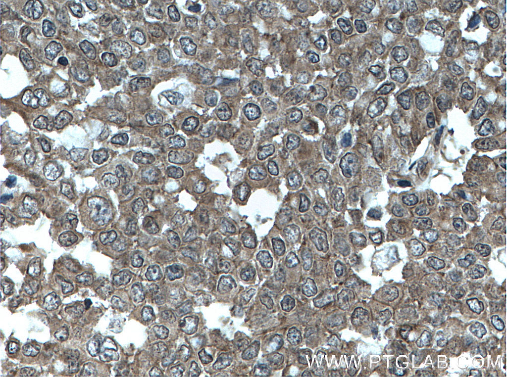 IHC staining of human colon cancer using 66627-1-Ig