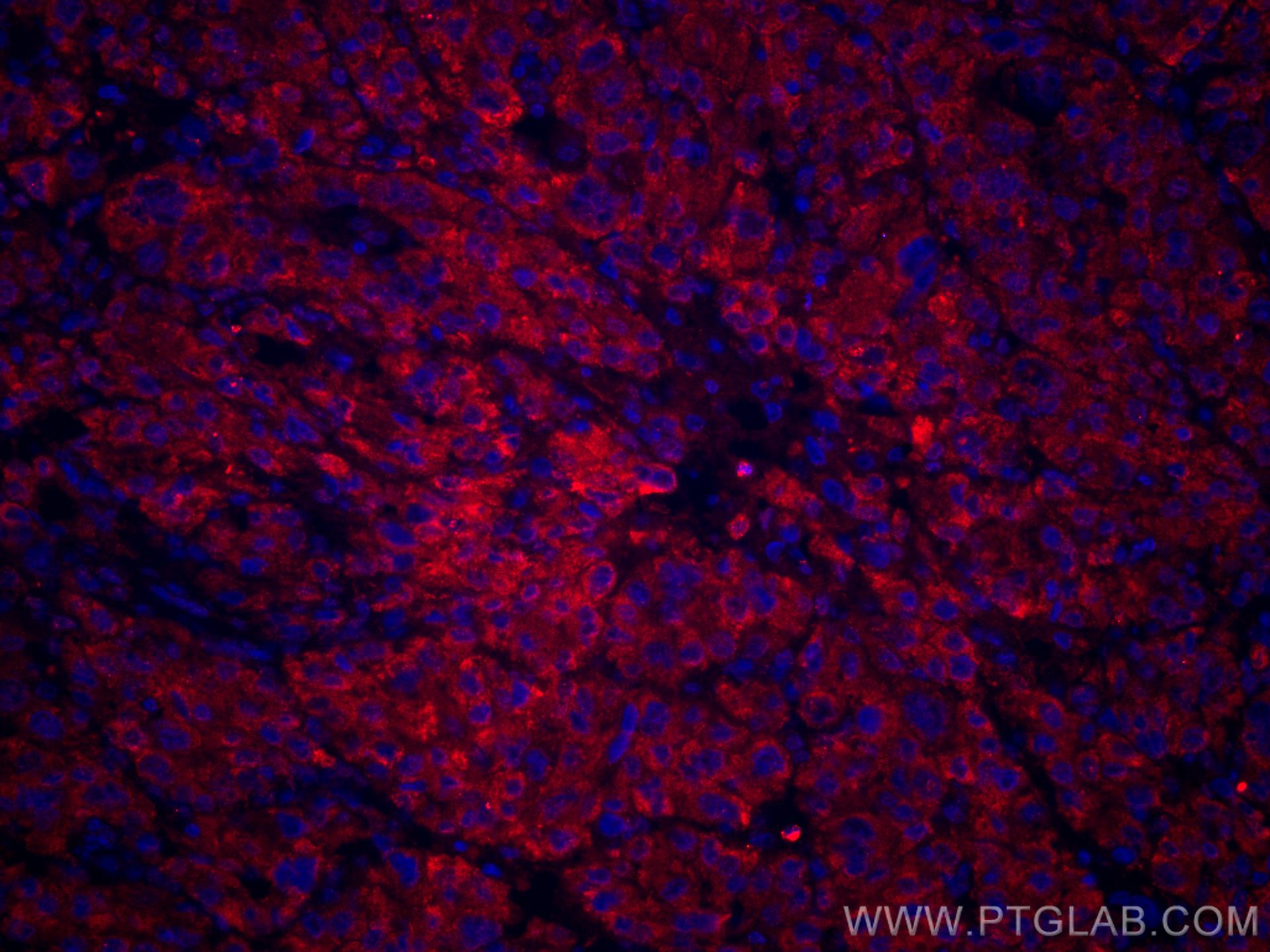 IF Staining of human liver cancer using CL594-66134