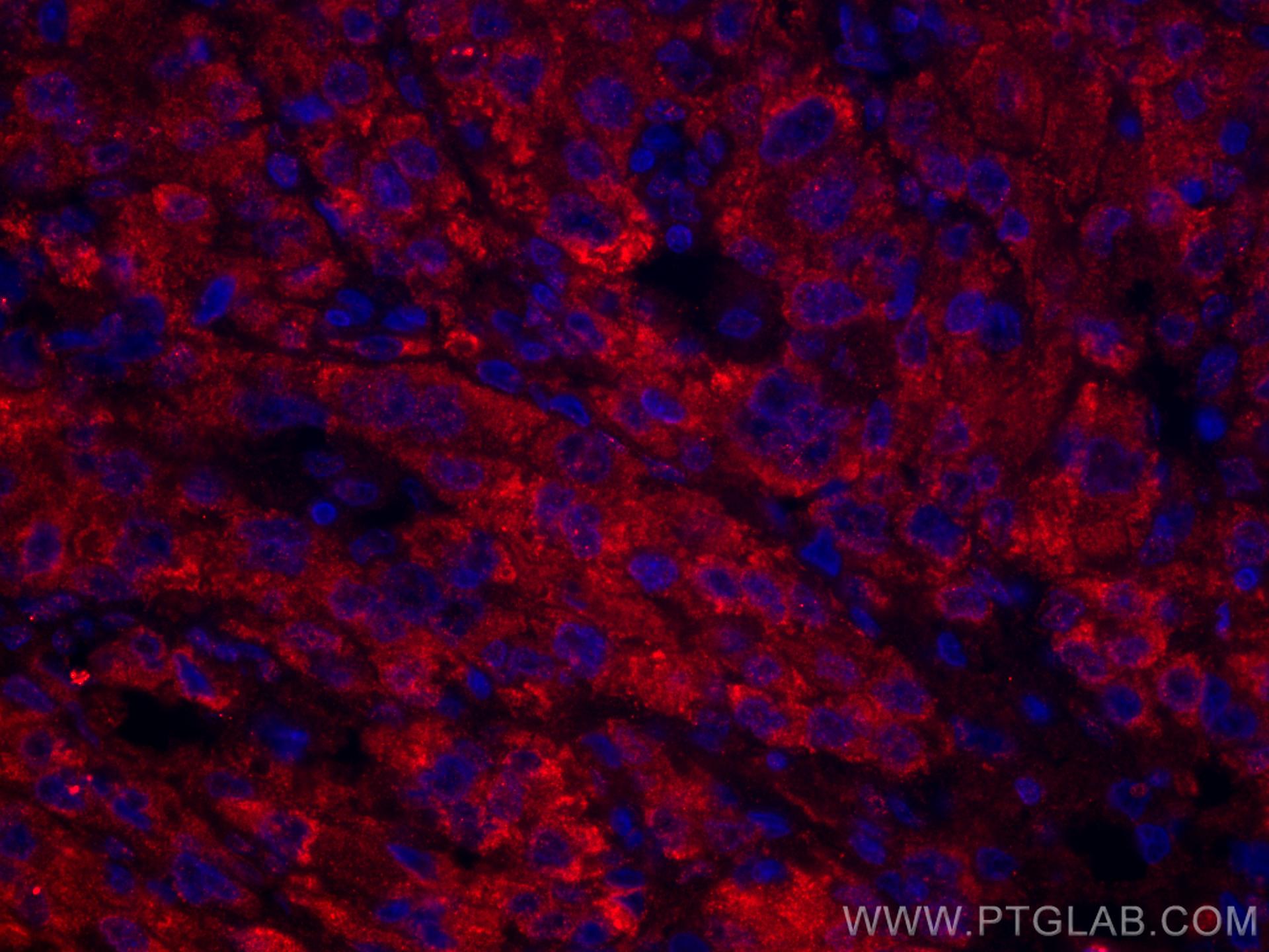 IF Staining of human liver cancer using CL594-66134